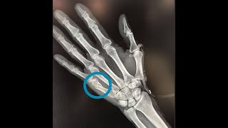 FRACTURA DEL BOXEADOR FRACTURA DEL QUINTO METACARPIANO CAUSAS SÍNTOMAS Y TRATAMIENTO