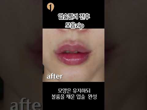 입술 필러 전후 모음 썸네일