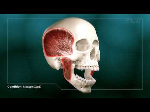 Malocclusion (Class II)