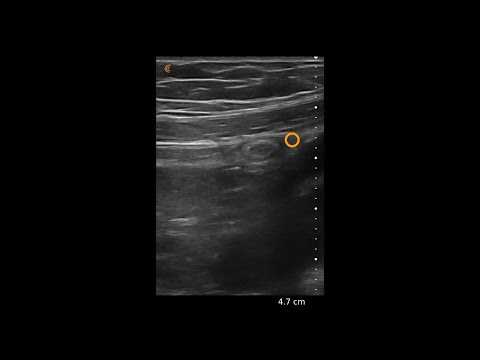 Appendicitis – Ultrasound Image Interpretation