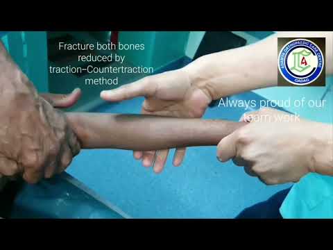 Fracture both bones forearm | Fracture with Displacement Correction | Closed reduction | Adamya Hsp