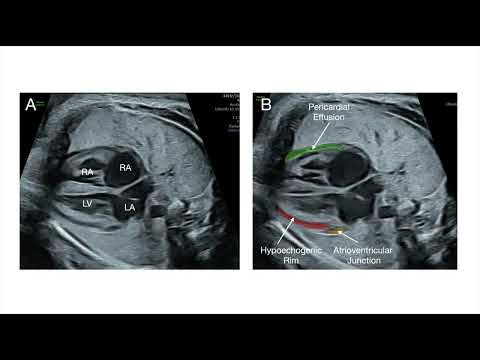 Enhancement of fetal cardiac screening as proposed by the ISUOG Practice Guidelines