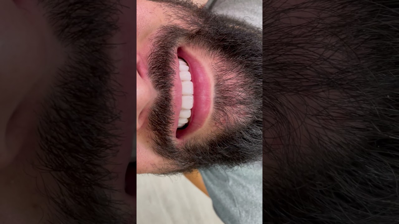 Sorriso Masculino Transformado