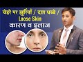 Chehre Ke Daag Dhabbe Jhuriyan Daane Loose Skin Pimples Dr Biswaroop Roy Chowdhury