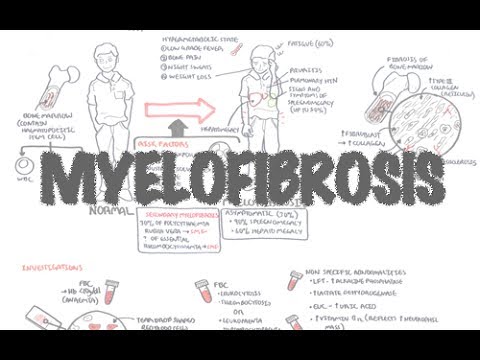 Primäre Myelofibrose - Übersicht (Präsentation, Pathophysiologie, Untersuchung, Behandlung)