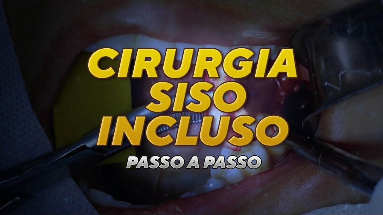 Cirurgia de Siso Incluso