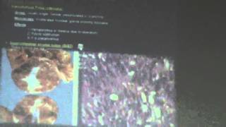 33) Dr. Wael Shawky 25-2-2016 [Tumors of Stomach till Gastric Polyps]