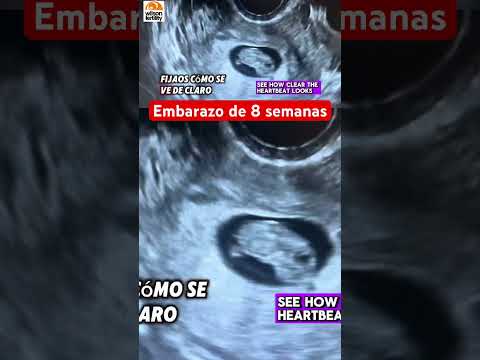 Embarazo de 8 semanas de gestación