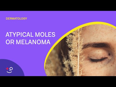 Atypical Moles or Melanoma: The ABCDE's [Dermatology]