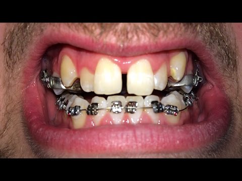 FULL BRACES TIME LAPSE