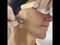 Carbon Laser Treatment For Skin Rejuvenation Shorts Lasertreatment