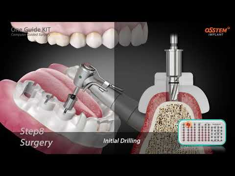 OneGuide KIT: Computer Guided Surgery