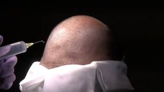 preview picture of video 'Los Gatos Near San Jose Male Bald Hair Transplant Restoration Surgery Dr. Diep www.mhtaclinic.com'