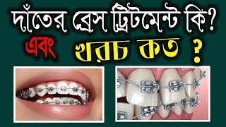 দাঁতে ব্রেস পড়ানোর খরচ কত টাকা || Orthodontics braces treatment cost ||dental brace.by smile bd.
