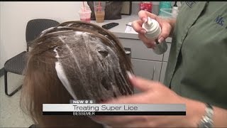 Treating super lice