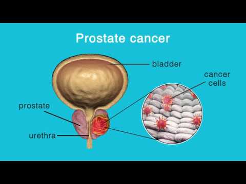 Prostatitis és szorongás