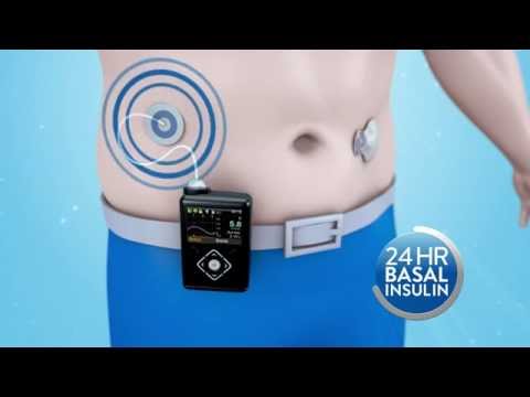 Medtronic 780G Insulin Pump Intro video