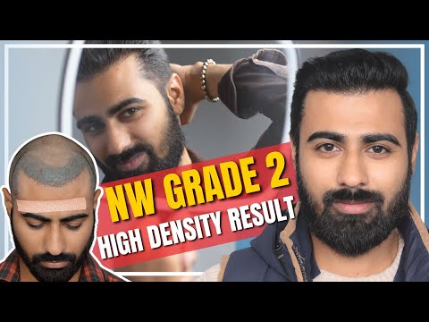 Hair Transplant in India | Best Results & Cost of Hair...