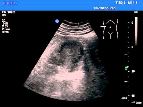 Guz nerki - rak nerkowokomórkowy Centrum USG Diagnoson Gdańsk