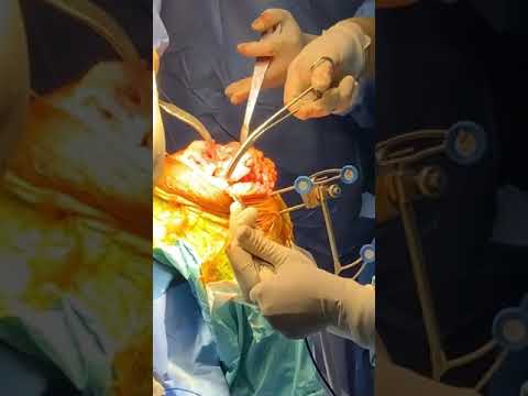 Robotic knee replacement surgery | Dr Hrushikesh Saraf