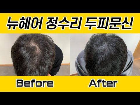 남자 두피문신 시술 전후 I 뉴헤어 SMP I Before&After