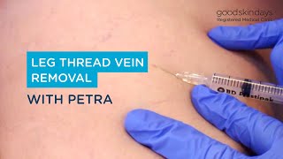 Leg Thread Vein Removal | Watch the Treatment