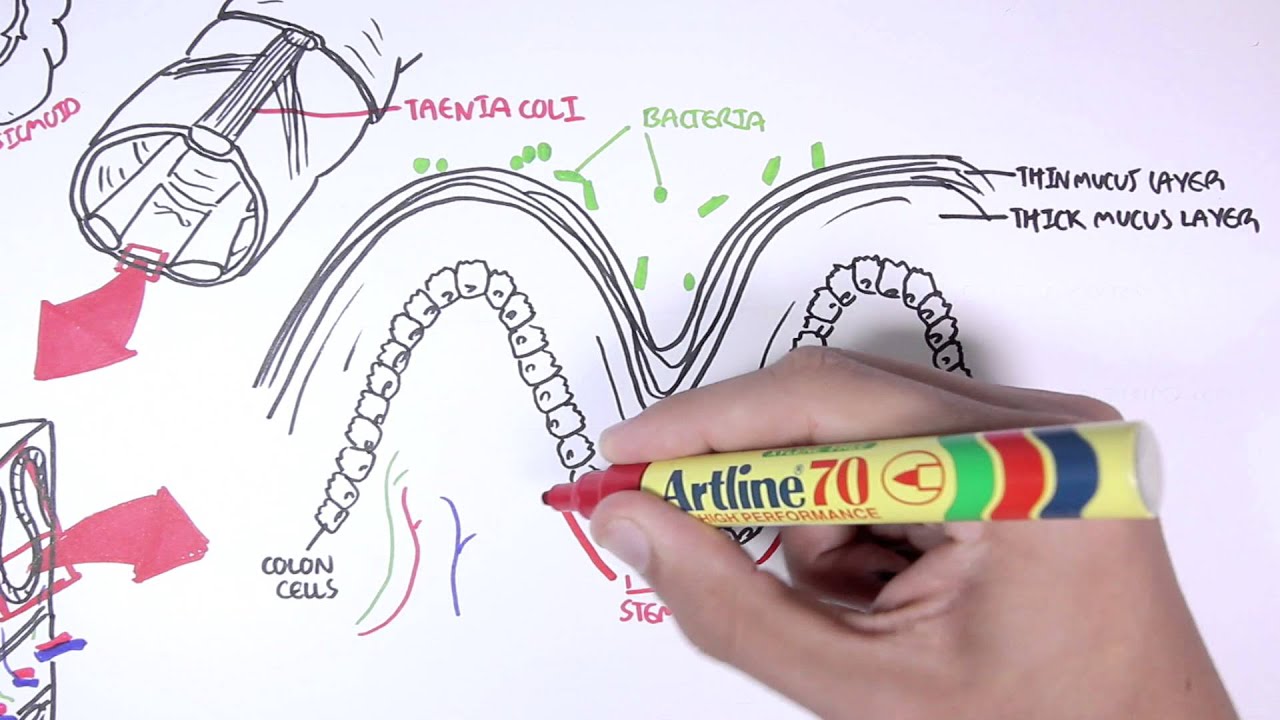 The Colon and Colon Cancer