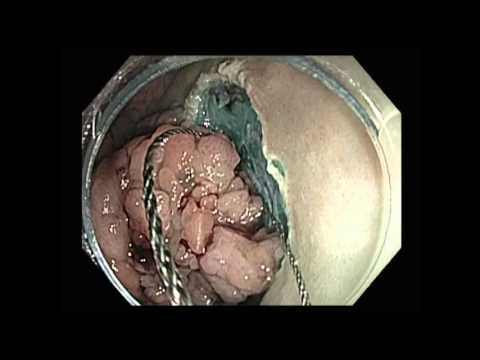 Rectum: 5-6 cm Laterally Spreading Tumor Type Granular - Piecemeal EMR