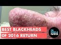 Best Of Dr Pimple Popper Blackheads 2016 Revisited 2018