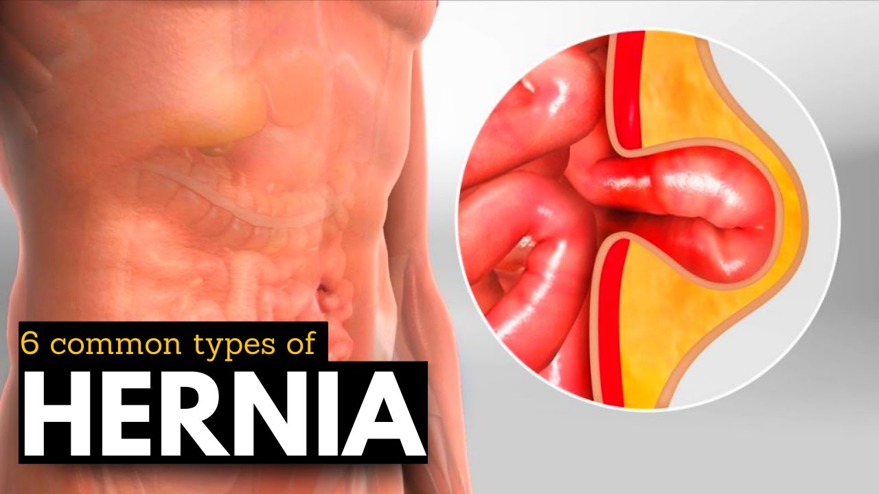 Hernia Breakdown: Discovering the 6 Most Prevalent Types
