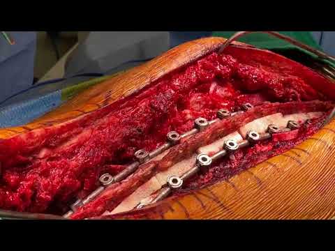 Spinal Fusion from T4-Pelvis