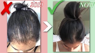 HOW I GREW MY HAIR BACK NATURALLY | Q&A, BEFORE & AFTERS, HAIR LOSS STORY | RESULTS IN JUST 1 MONTH