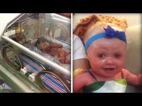 New York Baby's Skin Cracked Minutes After Her Birth Due to Rare Condition