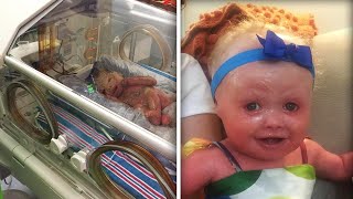 New York Baby's Skin Cracked Minutes After Her Birth Due to Rare Condition