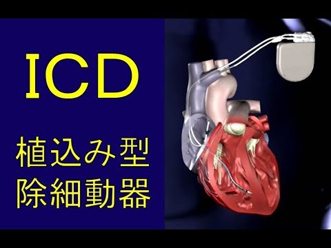 植込み型自動除細動器の定義