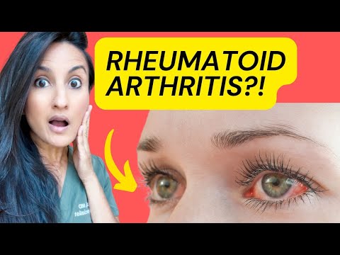 DON'T Ignore Eye Symptoms Of Rheumatoid Arthritis