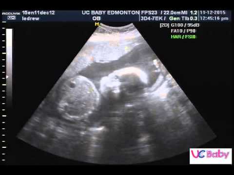 Baby Taryn Dec 11, 2015 UC Baby 3D Ultrasound
