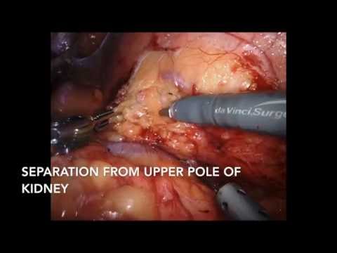 Robotic Left Adrenalectomy: Step-by-Step