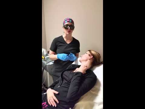 Acne treatment with Q - switch laser