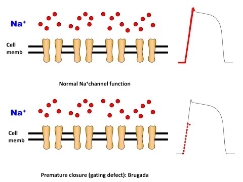 Mechanism of Brugada in a nutshell (English Version)