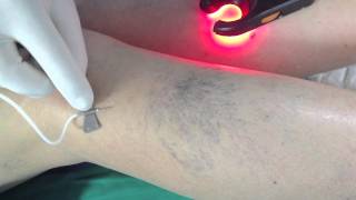 Esclerosis con espuma de vena nutricia de araña vascular (Varices en Murcia)