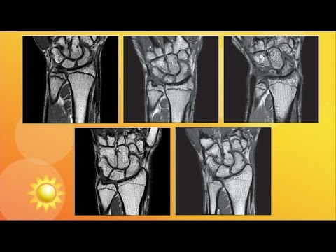Därför är det viktigt med åldersbestämning - Nyhetsmorgon (TV4)