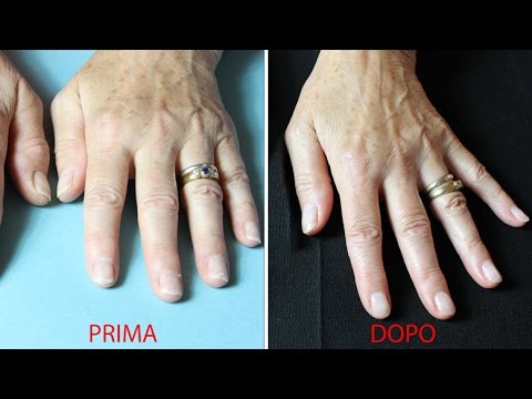 Analisi del sangue su sintomi lyambliya Come portare parassiti di sangue della persona