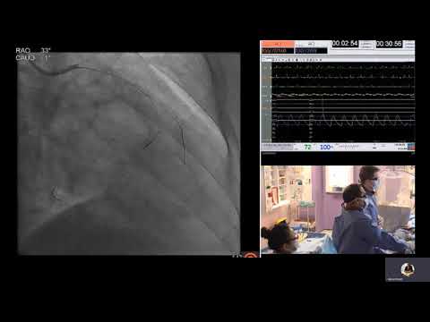 Retrograde PCI for RCA CTO using snare