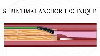 Subintimal Anchor Technique: Dual-Lumen Catheter Tutorial