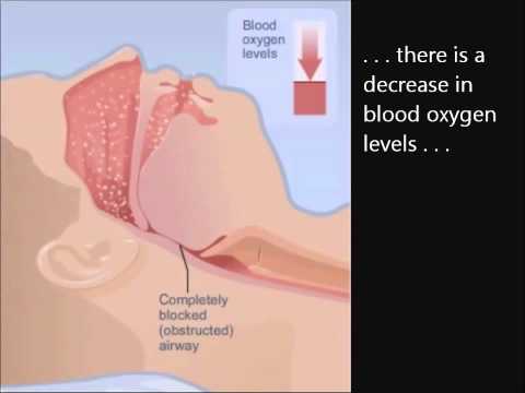 Understanding Cap and sleep apnea