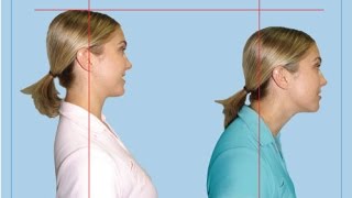 Why Cervical Kyphosis (Reversed Curve of Neck) Causes Disc Herniations &amp; Pinched Nerve / Dr Mandell