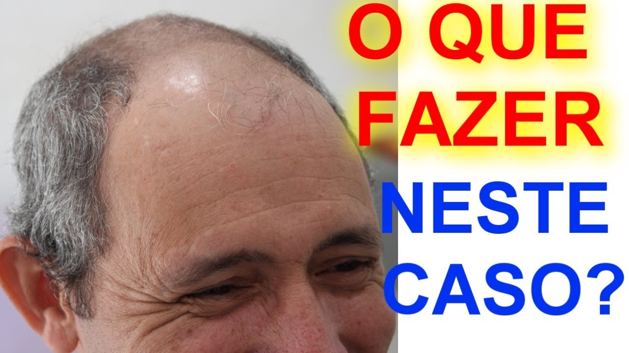 CORTE DE CABELO MAIS FACIL DO MUNDO COMO CORTAR CABELO DE MEIO CARECA