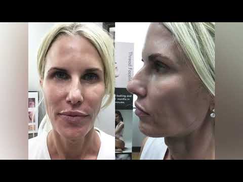 Experience Ferrer Aesthetics's Ultherapy with options for brow, chin, or face lift treatments up to 64% off - Second Medium