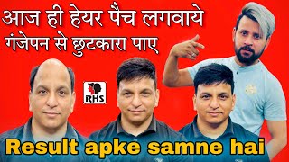 Hair Patch For Men | Natural look In Patch | Non surgical hair transplant | 9599858612